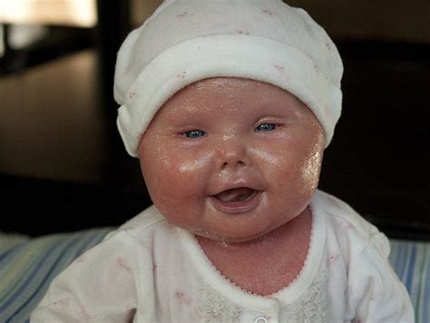 Approaches to prophylaxis and therapy: Meet Brenna, a baby with Harlequin Ichthyosis - Photo 17 ...