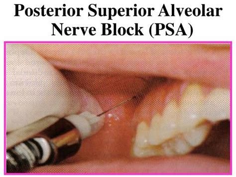 Ppt Maxillary Injection Techniques Powerpoint Presentation Id3480977