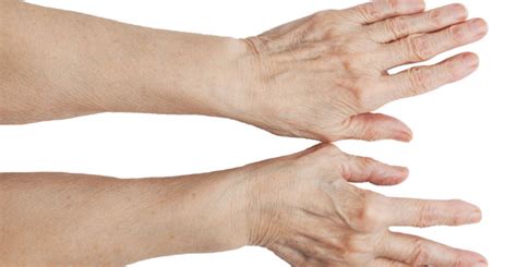 Causes Of Bulging Hand Veins And Treatment Veins On Hands Removal Miami
