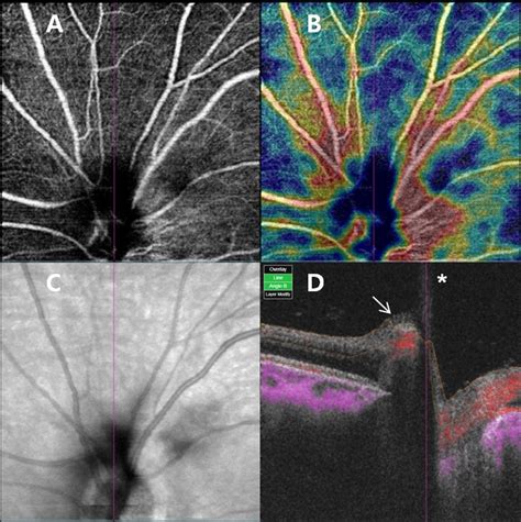 Optical Coherence Tomography Angiography Of The Optic Nerve Head Of The