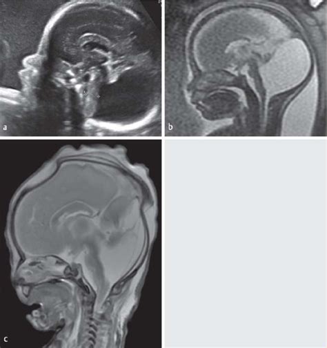 A Dandy Walker Malformation At 27 Weeks Of Gestation Mid Sagittal