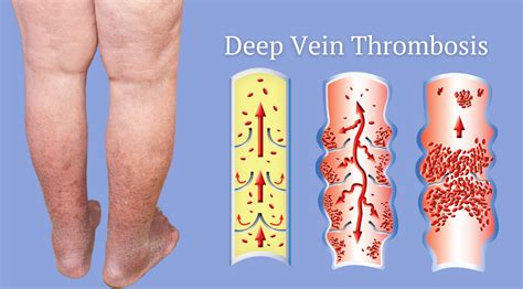 Deep Vein Thrombosis Dvt Treatments Monterey Bay Vascular