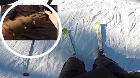 My Skiing Accident Broken Wrist Youtube