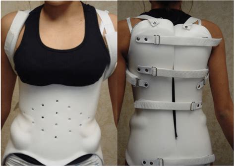 Bracing For Back Braces Treatments For Spinal Injury Nj And Nyc