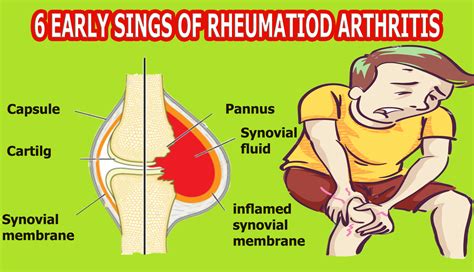 6 Early Signs Of Rheumatoid Arthritis In 2020 Rheumatoid Arthritis