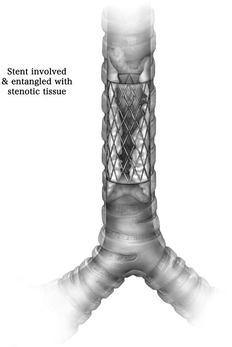 Bronchoscopic Extraction Of Incorporated Self Expanding Metallic Stents