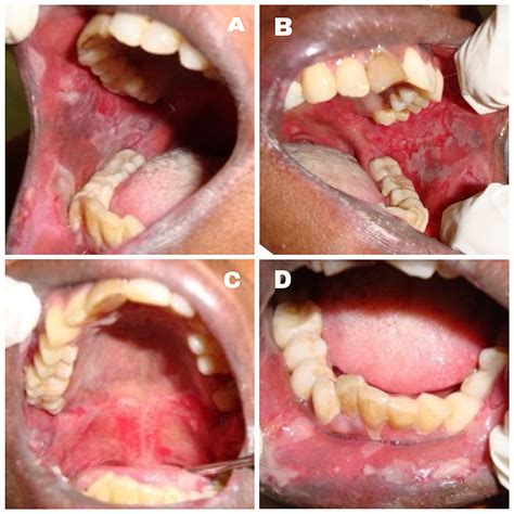 Bullous Pemphigoid In Oral Cavity