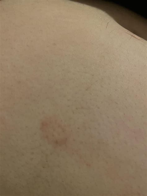 Does This Look Like Ringworm Doesnt Itch Been There A Few Weeks But