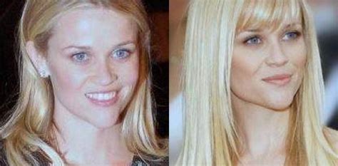 Reese Witherspoon Plastic Surgery Before And After Face Photos
