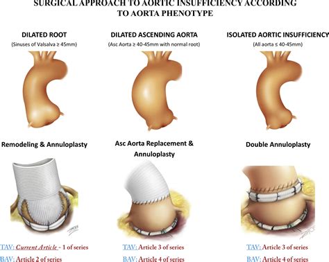 Valve Sparing Aortic Root Replacement Using The Remodeling Technique With Aortic Annuloplasty