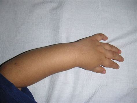 Arm Swelling Visual Diagnosis And Treatment In Pediatrics 3 Ed