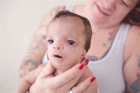 Photos Biological Mom Keeps Baby Born With Birth Defects After It S