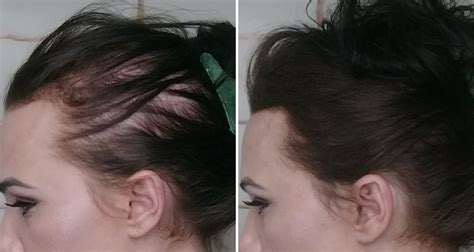 Minoxidil Before After Female