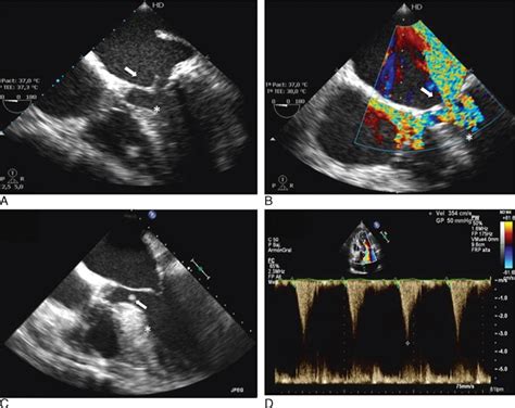 Examples Of Ie In 2 Hcm Patients A And B Mitral Valve Endocarditis