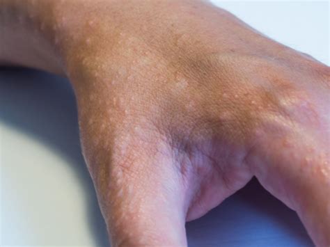 Dyshidrotic Dermatitis Symptoms Causes Diagnosis And Treatment