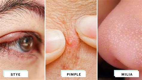 Discover More Than Pimple Under Eye Bag Latest In Cdgdbentre