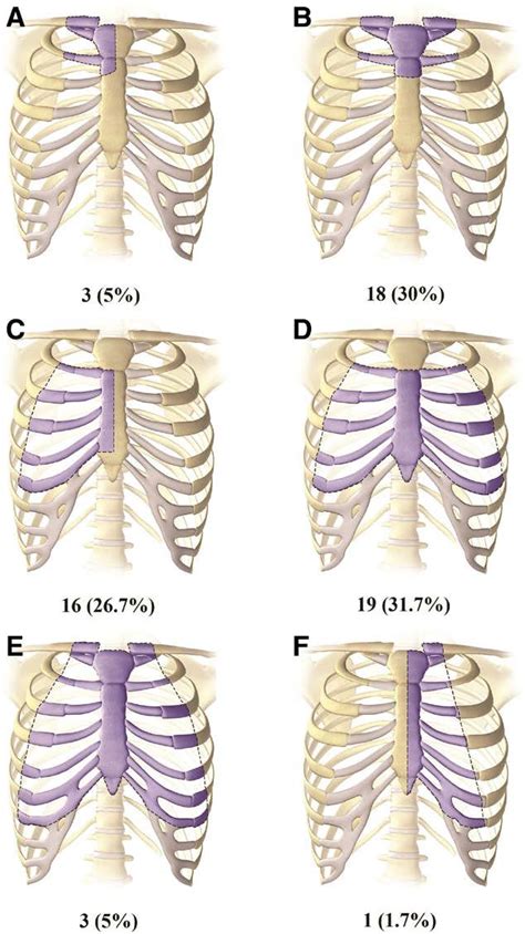 Thoracic Defects Of The Patients A Resection Involving Half Of The
