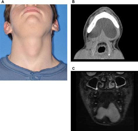 Floor Of Mouth Dermoid Cysts Report Of 3 Variants And A Suggested