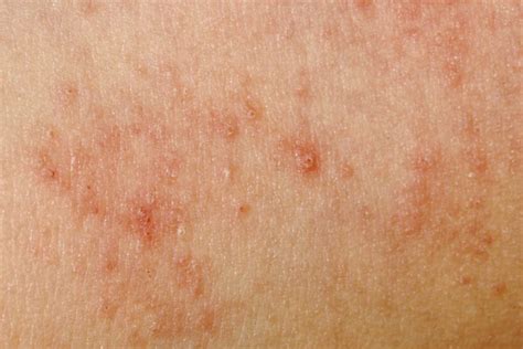 Eczema Causas Tipos Síntomas Y Tratamiento La Guía De Las Vitaminas