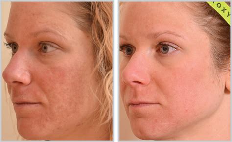 Laser Facial Treatment Before And After