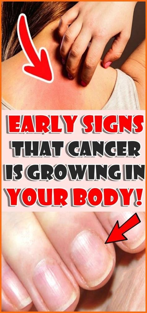 Early Signs That Cancer Is Growing In Your Body Cancer How Are You