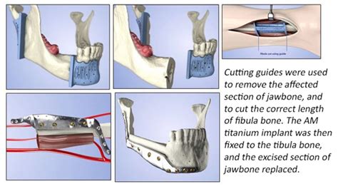 Uk Hospital Completes Jaw Reconstruction Using Bone Grafts With Metal