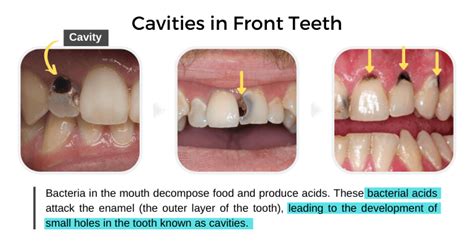 Cavities In Front Teeth Causes And Treatment Share Dental Care