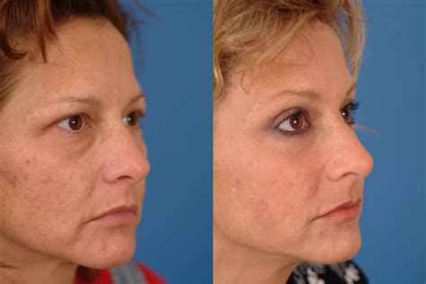 Midface Lift Before And After Photos Dr Benjamin Bassichis