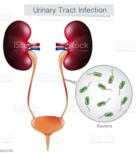 Urinary Tract Infection On White Background Stock Vector ...