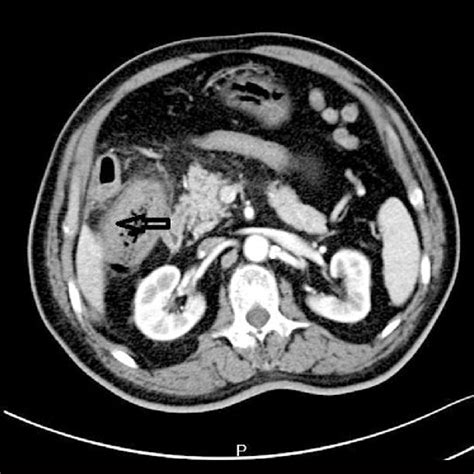 A Ct Scan With Contrast Showing Air In The Gallbladder Arrow