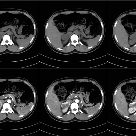 Computed Tomography Ct Scan Of The Right Adrenal Mass A The Mass