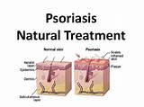 What Is The Latest Treatment For Psoriasis Photos