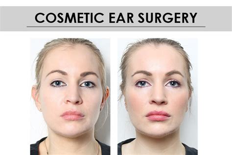 Cosmetic Ear Surgery