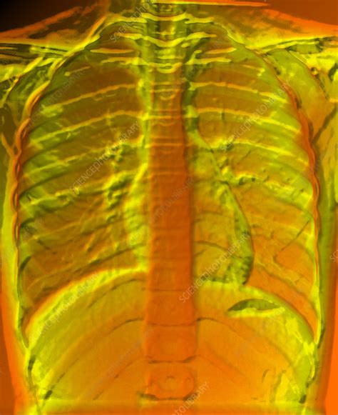 A Normal Chest X Ray Stock Image P5900247 Science Photo Library