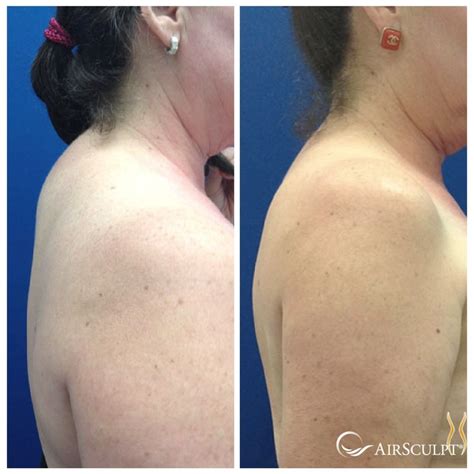 Pin On Airsculpt® Before And After Elite Body Sculpture