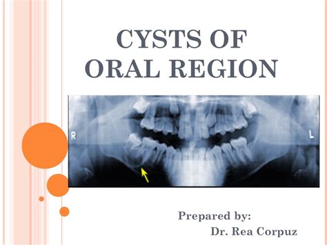 Cysts Of Oral Region 5