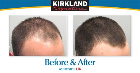 10 want to subscribe for updates? Minoxidil Before and After. A Few Photos to Encourage You!