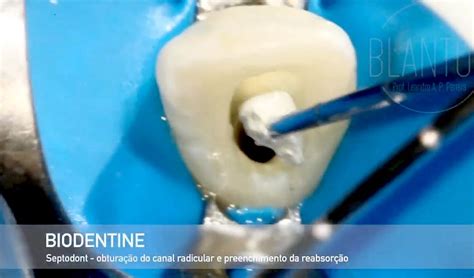 BIODENTINE O substituto dentinário bioativo que revoluciona sua prática
