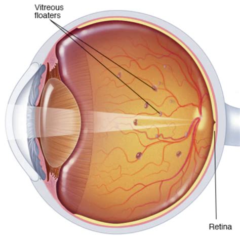 Are Floaters Dangerous A Sign Of Retinal Detachment Evershine Optical
