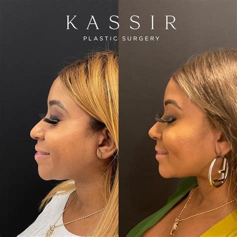 Black Ethnic Rhinoplasty Before And After Gallery — Kassir Plastic