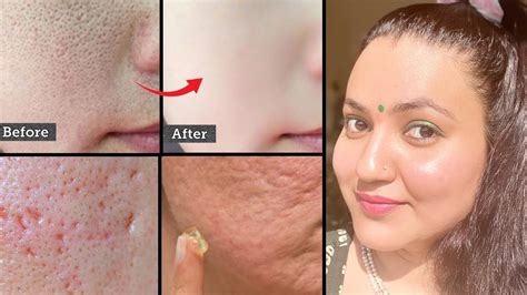 7 Days Skin Care Challenge Get Rid Of Open Pores Clogged Pores