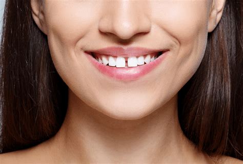 Diastema Or Gap Between Teeth Causes Treatment And Prevention