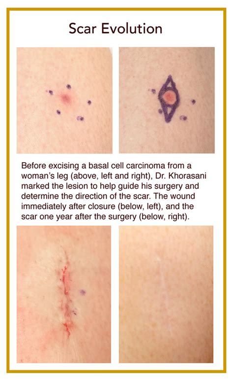 Embrace Your Scars Rochester Dermatologic Surgery Surgical