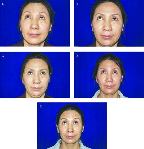A Photograph Of A 47 Year Old Woman With Moderate Forehead Lines