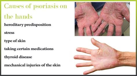 Psoriasis On The Hands And Palms Psoriasis Expert