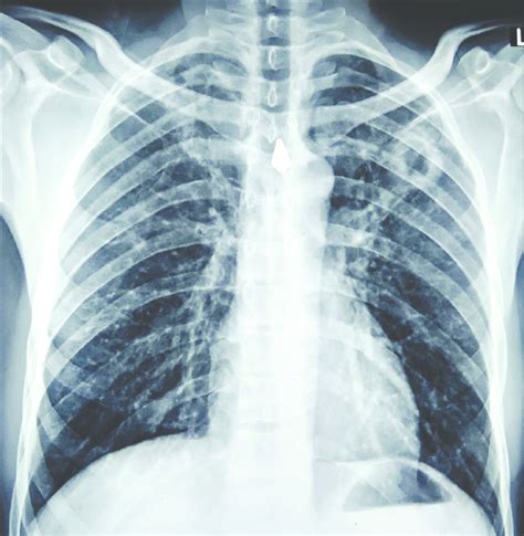 Initial Chest X Ray Posterior Anterior View Showed Right Apical My