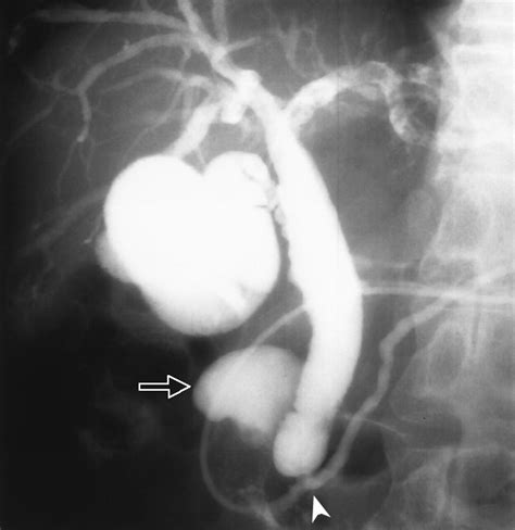Diagnostic Pitfalls Of Mr Cholangiopancreatography In The Evaluation Of