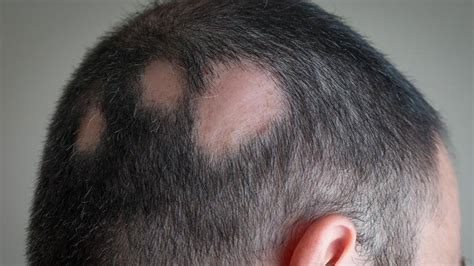 Alopecia Areata Quello Che Devi Sapere Insalaco Clinic