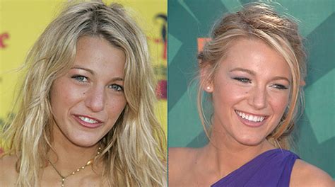 New Celebrity Buzz Blake Lively Nose Job Before After