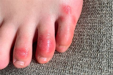 Covid Toes Other Rashes Latest Possible Rare Virus Signs Whyy